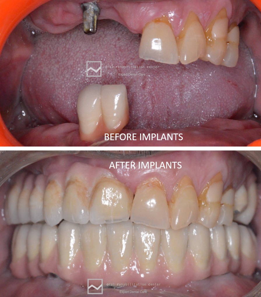 Before and after Dental Implants - Full arch restoration