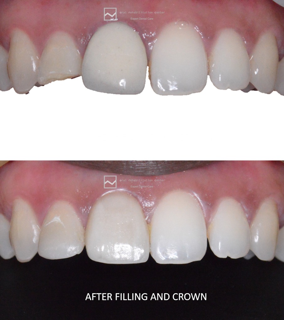 Before and after Crown & Filling - Aesthetic restoration