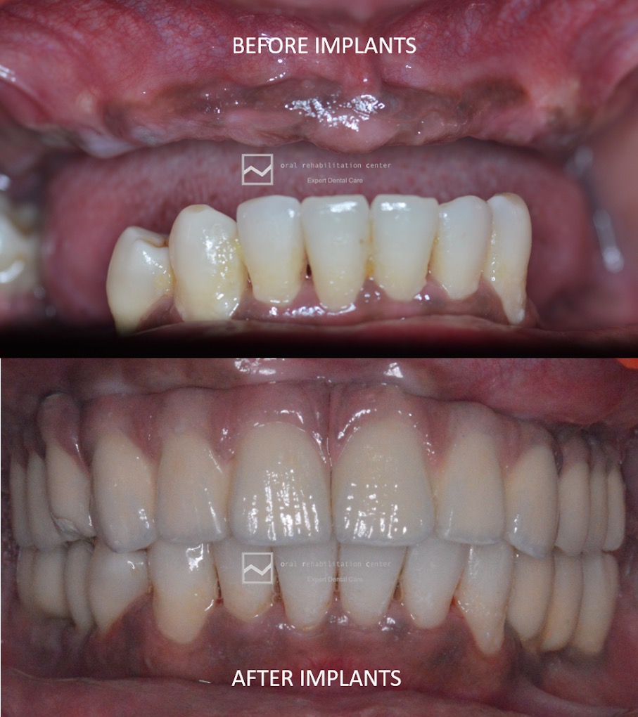 Before and after Dental Implants - Lower arch rehabilitation