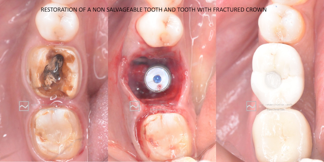 Before and after Tooth Restoration - Fractured crown repair